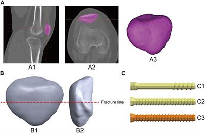 Tension band high-strength suture combined with absorbable cannulated screws for treating transverse patellar fractures: finite element analysis and clinical study